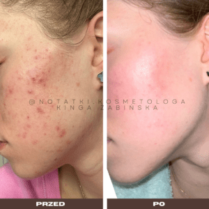 Przed i po metamorfoza skóry online konsultacja kosmetologiczna Beauty plan Kinga Żabińska notatki (10)