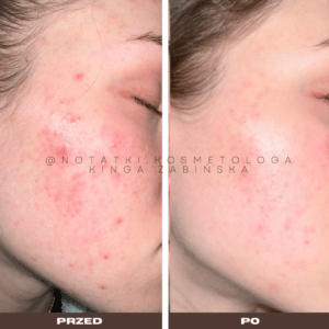 Przed i po metamorfoza skóry online konsultacja kosmetologiczna Beauty plan Kinga Żabińska notatki (12)