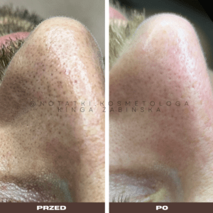 Przed i po metamorfoza skóry online konsultacja kosmetologiczna Beauty plan Kinga Żabińska notatki (13)