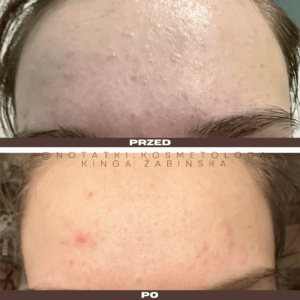 Przed i po metamorfoza skóry online konsultacja kosmetologiczna Beauty plan Kinga Żabińska notatki (15)