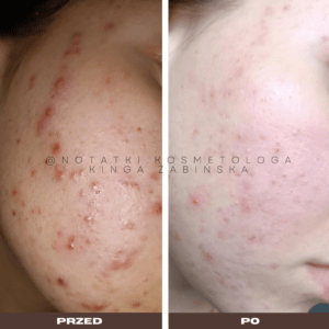 Przed i po metamorfoza skóry online konsultacja kosmetologiczna Beauty plan Kinga Żabińska notatki (17)