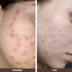 Przed i po metamorfoza skóry online konsultacja kosmetologiczna Beauty plan Kinga Żabińska notatki (18)