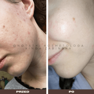 Przed i po metamorfoza skóry online konsultacja kosmetologiczna Beauty plan Kinga Żabińska notatki (21)