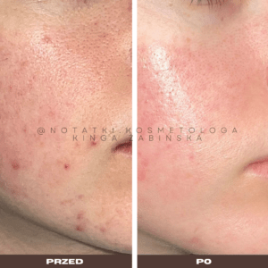 Przed i po metamorfoza skóry online konsultacja kosmetologiczna Beauty plan Kinga Żabińska notatki (22)