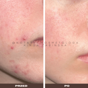 Przed i po metamorfoza skóry online konsultacja kosmetologiczna Beauty plan Kinga Żabińska notatki (23)