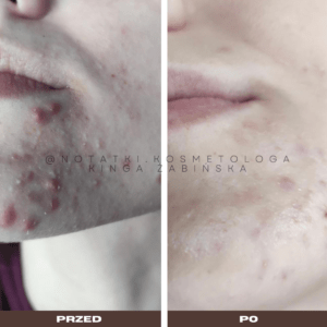 Przed i po metamorfoza skóry online konsultacja kosmetologiczna Beauty plan Kinga Żabińska notatki (29)