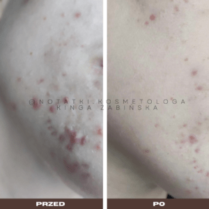 Przed i po metamorfoza skóry online konsultacja kosmetologiczna Beauty plan Kinga Żabińska notatki (30)