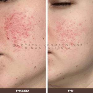Przed i po metamorfoza skóry online konsultacja kosmetologiczna Beauty plan Kinga Żabińska notatki (6)