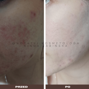 Przed i po metamorfoza skóry online konsultacja kosmetologiczna Beauty plan Kinga Żabińska notatki (7)