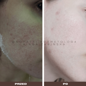 Przed i po metamorfoza skóry online konsultacja kosmetologiczna Beauty plan Kinga Żabińska notatki (8)