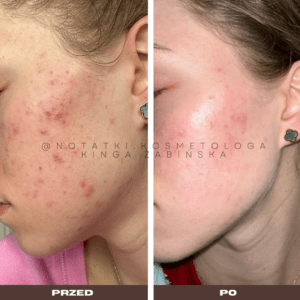 Przed i po metamorfoza skóry online konsultacja kosmetologiczna Beauty plan Kinga Żabińska notatki (9)