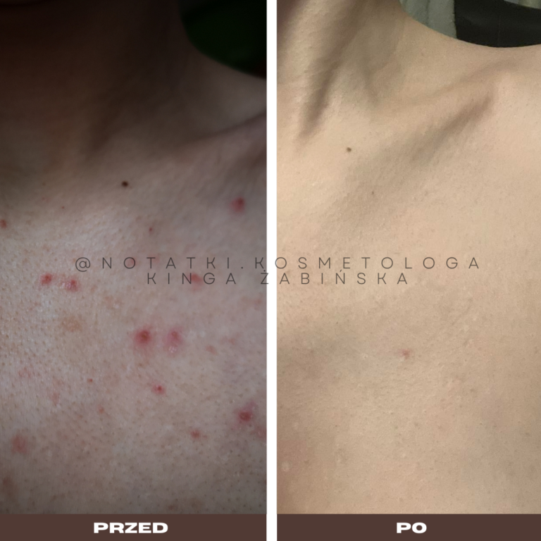 10 Przed i po metamorfoza skóry online konsultacja kosmetologiczna Beauty plan Kinga Żabińska notatki (31)