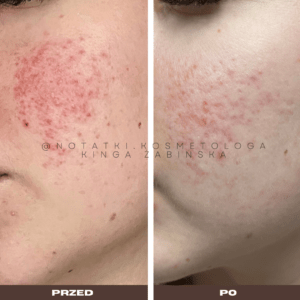 12 Przed i po metamorfoza skóry online konsultacja kosmetologiczna Beauty plan Kinga Żabińska notatki (5)