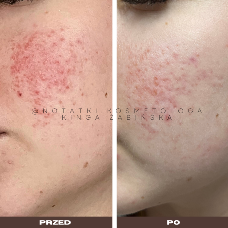12 Przed i po metamorfoza skóry online konsultacja kosmetologiczna Beauty plan Kinga Żabińska notatki (5)