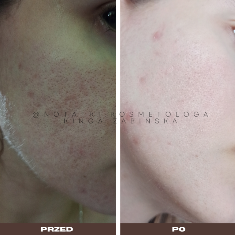 13 Przed i po metamorfoza skóry online konsultacja kosmetologiczna Beauty plan Kinga Żabińska notatki (8)