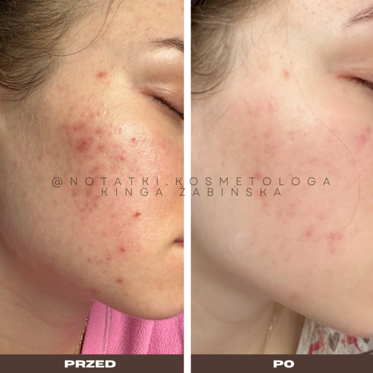 14 Przed i po metamorfoza skóry online konsultacja kosmetologiczna Beauty plan Kinga Żabińska notatki (11)