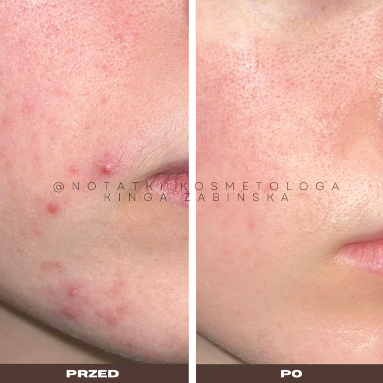 18 Przed i po metamorfoza skóry online konsultacja kosmetologiczna Beauty plan Kinga Żabińska notatki (23)
