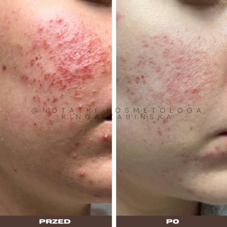 2 Przed i po metamorfoza skóry online konsultacja kosmetologiczna Beauty plan Kinga Żabińska notatki (4)