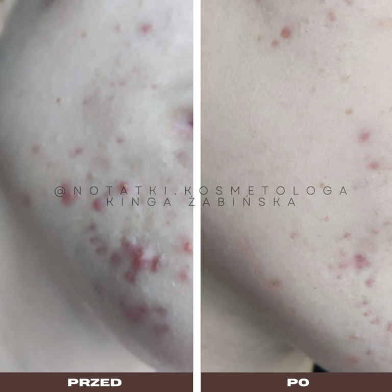 20 Przed i po metamorfoza skóry online konsultacja kosmetologiczna Beauty plan Kinga Żabińska notatki (30)