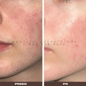 22 Przed i po metamorfoza skóry online konsultacja kosmetologiczna Beauty plan Kinga Żabińska notatki (24)