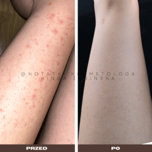 24 Przed i po metamorfoza skóry online konsultacja kosmetologiczna Beauty plan Kinga Żabińska notatki (34)