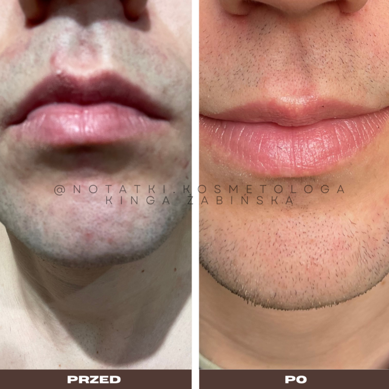 26 Przed i po metamorfoza skóry online konsultacja kosmetologiczna Beauty plan Kinga Żabińska notatki (37)