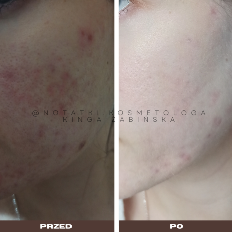 3 Przed i po metamorfoza skóry online konsultacja kosmetologiczna Beauty plan Kinga Żabińska notatki (7)