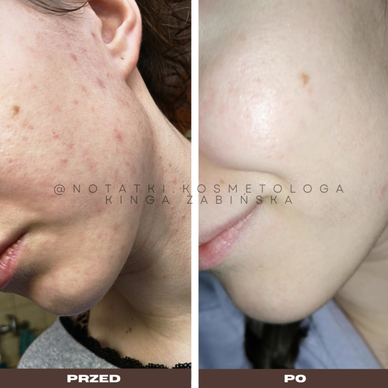 6 Przed i po metamorfoza skóry online konsultacja kosmetologiczna Beauty plan Kinga Żabińska notatki (21)