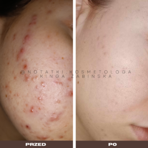 przed i po metamorfoza skórna trądzik wyrpyski kosmetolog holistyczny kinga żabińska tarnów online współpraca kosmetologiczna ebook beauty plan (7)124 e