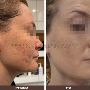 przed i po metamorfoza skórna trądzik wyrpyski kosmetolog holistyczny kinga żabińska tarnów online współpraca kosmetologiczna ebook beauty plan (1)