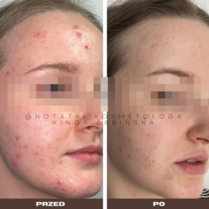 przed i po metamorfoza skórna trądzik wyrpyski kosmetolog holistyczny kinga żabińska tarnów online współpraca kosmetologiczna ebook beauty plan (11)