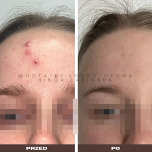 przed i po metamorfoza skórna trądzik wyrpyski kosmetolog holistyczny kinga żabińska tarnów online współpraca kosmetologiczna ebook beauty plan (12)