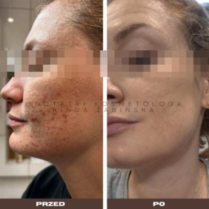 przed i po metamorfoza skórna trądzik wyrpyski kosmetolog holistyczny kinga żabińska tarnów online współpraca kosmetologiczna ebook beauty plan (2)