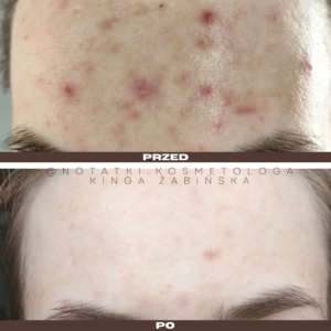 przed i po metamorfoza skórna trądzik wyrpyski kosmetolog holistyczny kinga żabińska tarnów online współpraca kosmetologiczna ebook beauty plan (2)124