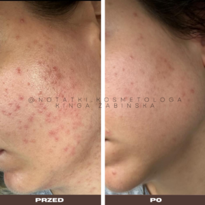 przed i po metamorfoza skórna trądzik wyrpyski kosmetolog holistyczny kinga żabińska tarnów online współpraca kosmetologiczna ebook beauty plan (3)124