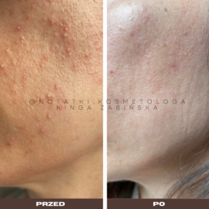 przed i po metamorfoza skórna trądzik wyrpyski kosmetolog holistyczny kinga żabińska tarnów online współpraca kosmetologiczna ebook beauty plan (71)