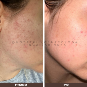 przed i po metamorfoza skórna trądzik wyrpyski kosmetolog holistyczny kinga żabińska tarnów online współpraca kosmetologiczna ebook beauty plan (7)124