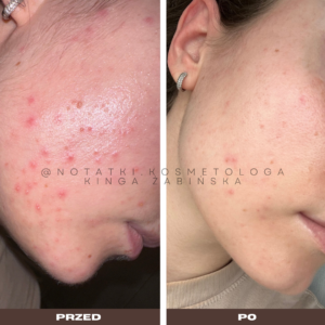 przed i po metamorfoza skórna trądzik wyrpyski kosmetolog holistyczny kinga żabińska tarnów online współpraca kosmetologiczna ebook beauty plan (76)
