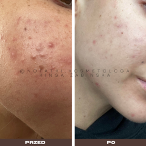 przed i po metamorfoza skórna trądzik wyrpyski kosmetolog holistyczny kinga żabińska tarnów online współpraca kosmetologiczna ebook beauty plan (9)124