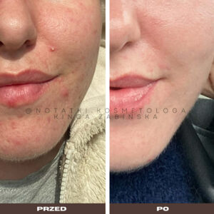 przed-i-po-metamorfoza-skorna-tradzik-wyrpyski-kosmetolog-holistyczny-kinga-zabinska-tarnow-online-wspolpraca-kosmetologiczna-ebook-beauty-plan notatki (1)