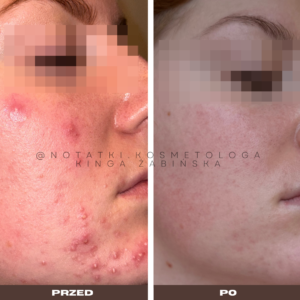 przed-i-po-metamorfoza-skorna-tradzik-wyrpyski-kosmetolog-holistyczny-kinga-zabinska-tarnow-online-wspolpraca-kosmetologiczna-ebook-beauty-plan notatki (1)