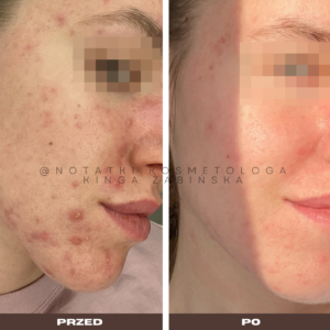 przed-i-po-metamorfoza-skorna-tradzik-wyrpyski-kosmetolog-holistyczny-kinga-zabinska-tarnow-online-wspolpraca-kosmetologiczna-ebook-beauty-plan notatki (2)