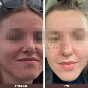 przed-i-po-metamorfoza-skorna-tradzik-wyrpyski-kosmetolog-holistyczny-kinga-zabinska-tarnow-online-wspolpraca-kosmetologiczna-ebook-beauty-plan notatki (3)