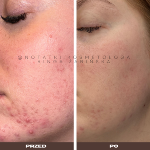 przed-i-po-metamorfoza-skorna-tradzik-wyrpyski-kosmetolog-holistyczny-kinga-zabinska-tarnow-online-wspolpraca-kosmetologiczna-ebook-beauty-plan notatki (4)