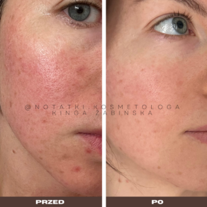 przed-i-po-metamorfoza-skorna-tradzik-wyrpyski-kosmetolog-holistyczny-kinga-zabinska-tarnow-online-wspolpraca-kosmetologiczna-ebook-beauty-plan notatki (5)